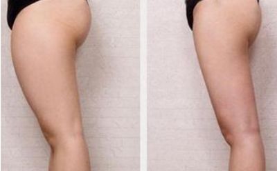 商丘做雙眼皮去哪家好？選擇最適合自己的雙眼皮整形醫(yī)院