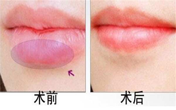 2023臺州超聲刀祛除妊娠紋上榜清單前十名專家(李影影、沈正洲、林子豪從評價看挺正規(guī))