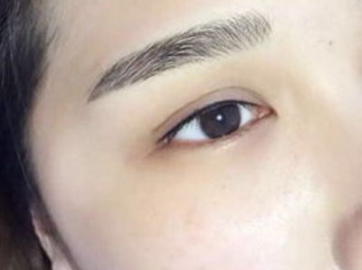 重慶美萊鄭楠醫(yī)生：割雙眼皮優(yōu)質(zhì)手術(shù)案例揭秘，打造自然美麗雙眼！