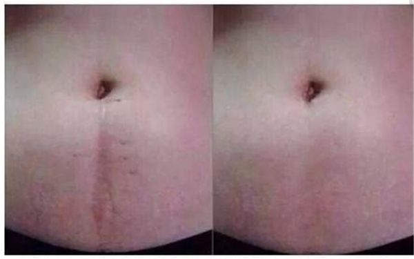 深圳哪家醫(yī)院專業(yè)治療傷疤效果好？