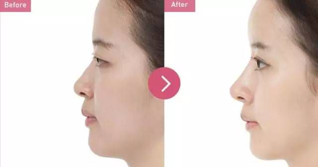 2023寧波面部埋線提升美容口碑前10位醫(yī)生(雷中元、姚遠(yuǎn)、馬文章靠譜技術(shù)好！)