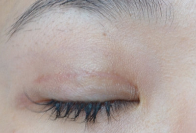 2023北京愛(ài)貝芙注射填充去痘疤醫(yī)生前10強(qiáng)排行(劉健、解永學(xué)、葉宇盤點(diǎn)實(shí)力派，特點(diǎn)對(duì)比！)