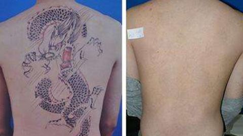 怎樣修復(fù)鄭荃疤痕，讓人滿意？