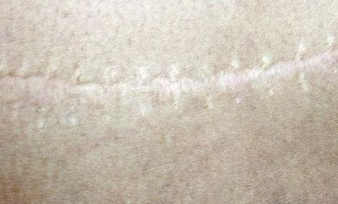 聊城玻尿酸隆鼻哪家好？專業(yè)醫(yī)生推薦幫助您選擇