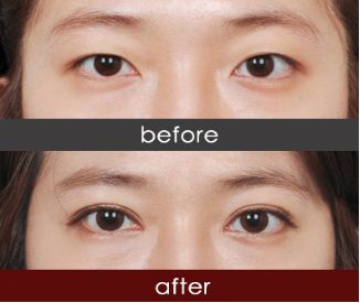 恩施市哪家醫(yī)院注射除皺針效果好推薦？