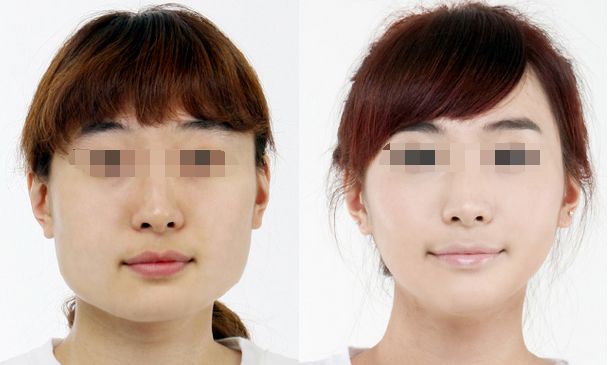 合肥哪家醫(yī)院豐胸效果好，專(zhuān)業(yè)的豐胸醫(yī)院推薦