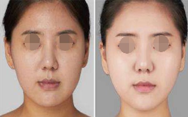 無錫割雙眼皮方案及費用詳解，雙眼皮手術有哪些優(yōu)勢？