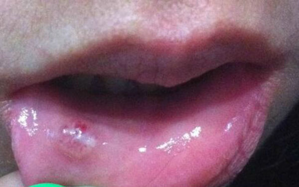 恩施痤瘡激光醫(yī)生