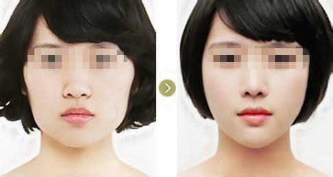 蕪湖射頻點(diǎn)陣激光痘坑醫(yī)生