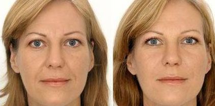 北京公立三甲醫(yī)院蘋果肌凹陷填充實(shí)力詳解！