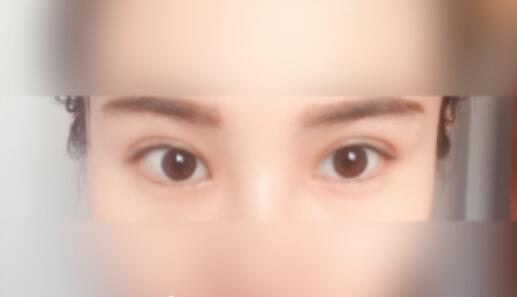 延吉金光善整形雙眼皮一個月效果分享，有對比圖