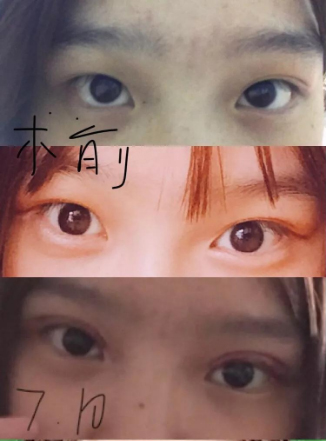 做雙眼皮案例，濟南坤如瑪麗崔金珍雙眼皮案例圖片