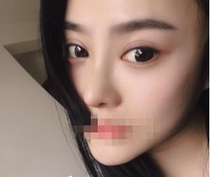 重慶星范整形超體隆鼻一個月效果 重慶星范整形超體隆鼻一個月效果