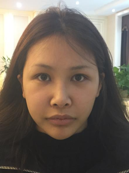 長春中研整形黃帝云鼻頭縮小術(shù)后三個月效果反饋圖