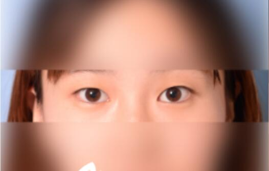 延吉金光善整形雙眼皮一個月效果分享，有對比圖