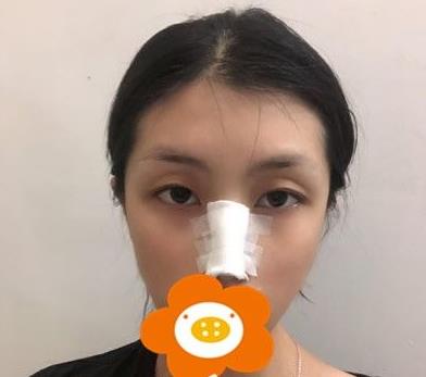 溫州韓美周杰群醫(yī)生耳軟骨隆鼻案例分享術后即刻 溫州韓美周杰群醫(yī)生耳軟骨隆鼻案例分享術后即刻