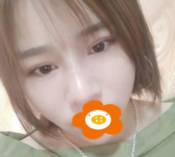 據(jù)說杭州薇琳隆鼻后效果很自然，有案例嗎