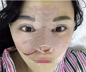 重慶星范整形超體隆鼻術(shù)后兩天效果 重慶星范整形超體隆鼻術(shù)后兩天效果