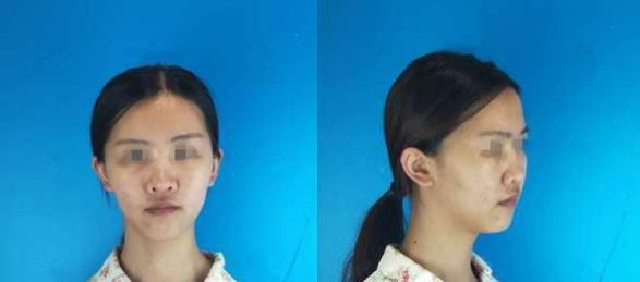 朋友推薦到濱州醫(yī)學(xué)院附屬醫(yī)院做隆鼻，效果還挺不錯