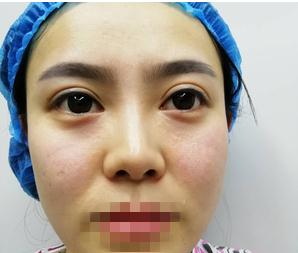 親身經(jīng)驗(yàn)，重慶星范整形的超體隆鼻真的很自然