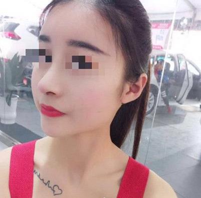 石家莊諾萬整形姚華榮硅膠隆鼻案例分享術(shù)前效果后三個(gè)月效果 石家莊諾萬整形姚華榮硅膠隆鼻案例分享術(shù)前效果后三個(gè)月效果