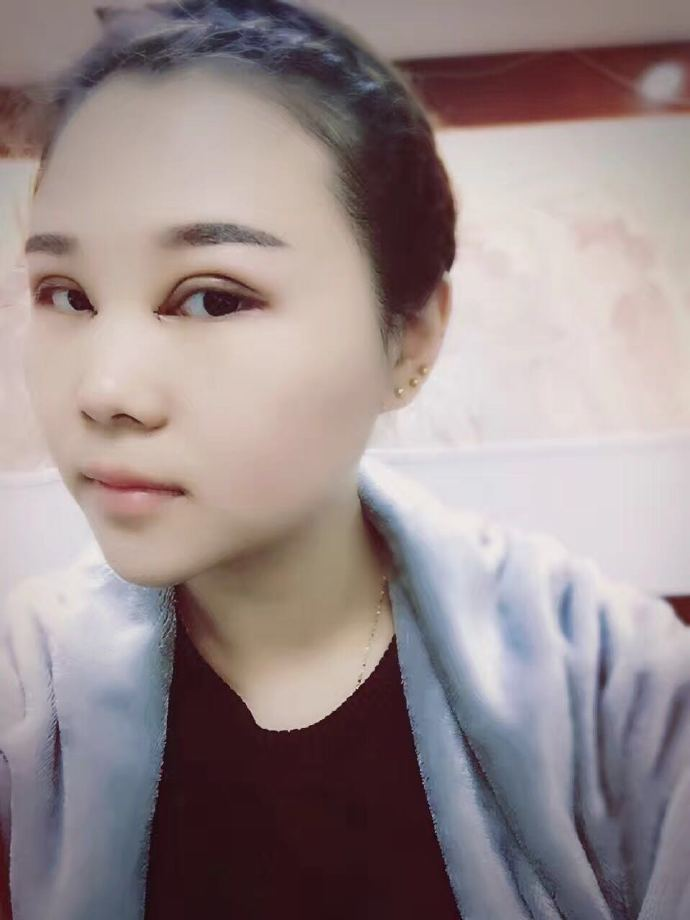 腫眼泡應該做哪種雙眼皮？汕頭曙光雙眼皮三個月效果分享