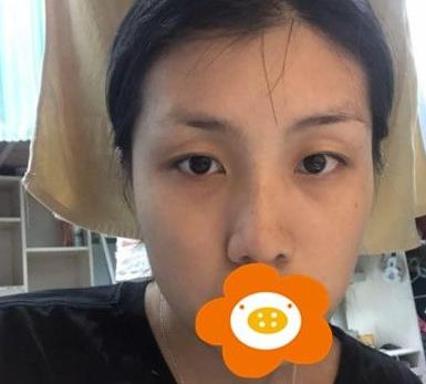 救命，周杰群做的耳軟骨隆鼻恢復(fù)后鼻背線條也太好看了吧