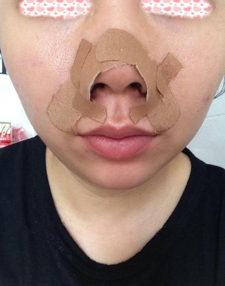 像我一樣寬鼻翼的小姐姐們可以放心找李旭平做隆鼻了，親測(cè)好評(píng)