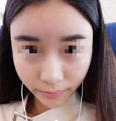 石家莊諾萬整形姚華榮硅膠隆鼻效果分享，同款酒糟鼻值得一試