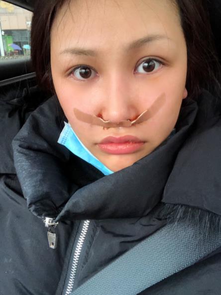 長春中研整形黃帝云鼻頭縮小案例術(shù)后第二天 長春中研整形黃帝云鼻頭縮小案例術(shù)后第二天