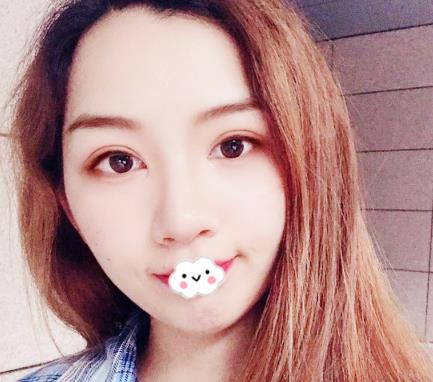 武漢伊萊美割雙眼皮怎么樣？切開雙眼皮恢復(fù)過程圖