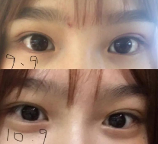 做雙眼皮案例，濟南坤如瑪麗崔金珍雙眼皮案例圖片