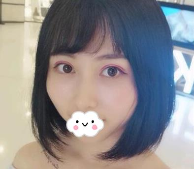 武漢亞太整形雙眼皮術(shù)后一個月效果分享