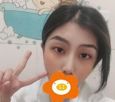 溫州韓美周杰群醫(yī)生耳軟骨隆鼻案例分享術后三個月效果 溫州韓美周杰群醫(yī)生耳軟骨隆鼻案例分享術后三個月效果
