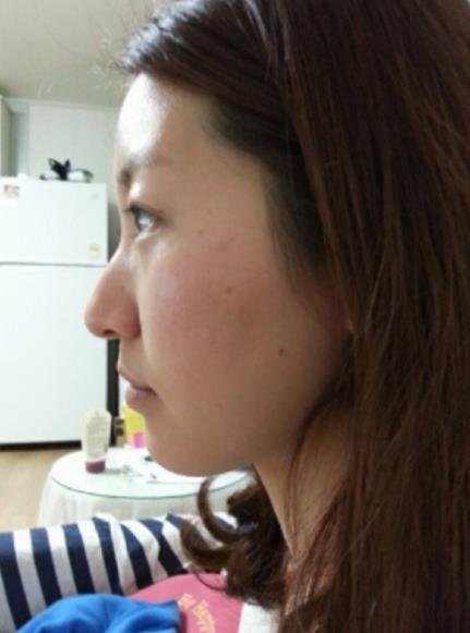 原來(lái)駝峰鼻整完這么好看，我再也不是丑美丑美的了