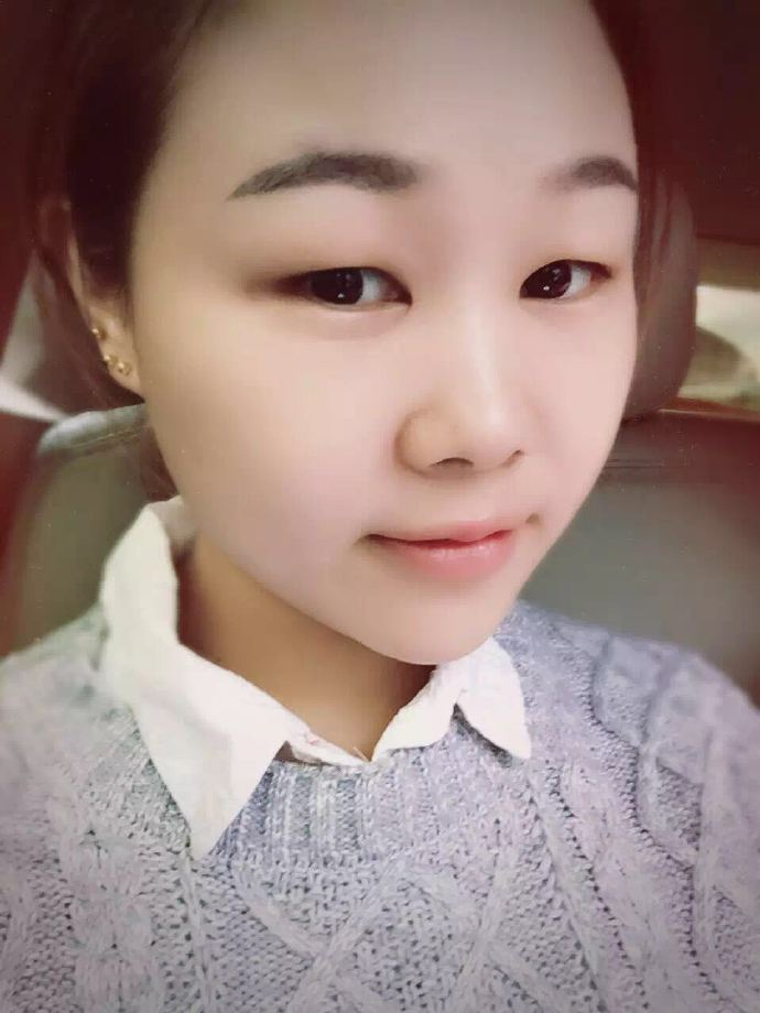 腫眼泡應該做哪種雙眼皮？汕頭曙光雙眼皮三個月效果分享