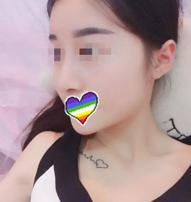 石家莊諾萬整形姚華榮硅膠隆鼻案例分享術(shù)后一個(gè)月效果 石家莊諾萬整形姚華榮硅膠隆鼻案例分享術(shù)后一個(gè)月效果