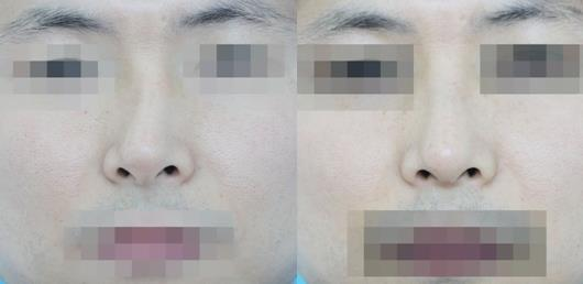 不要被營銷號帶偏了，鼻骨矯正其實很簡單