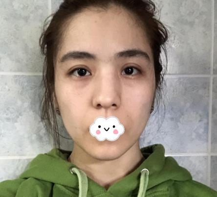 大連沙醫(yī)生整形付德林做的自體軟骨隆鼻效果，給大家做個參考