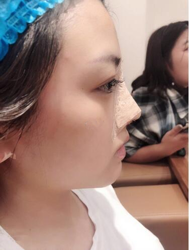 廈門海峽整形鼻綜合案例術(shù)后第二天