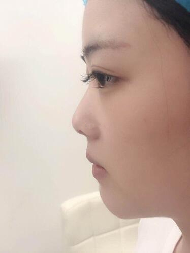 廈門海峽整形鼻綜合案例分享，這鼻子可以滑滑梯了