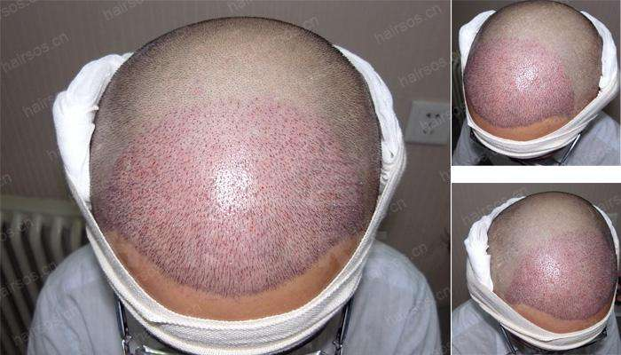 南京美貝爾發(fā)際線種植案例分享，不僅年輕還顯臉小