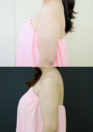 揭陽美萊整形手臂吸脂案例分享，輕松告別拜拜肉