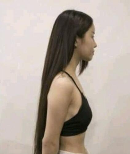 濟(jì)南海峽整形假體隆胸半年效果，夏天就是拼身材的時(shí)候