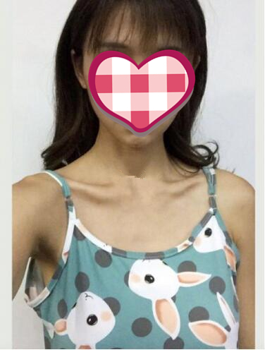 濟南美爾雅整形自體脂肪隆胸半年效果反饋，我都想摸摸看