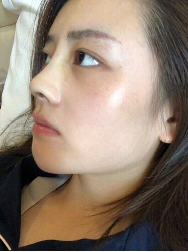 廈門海峽整形鼻綜合案例術(shù)后一個(gè)月