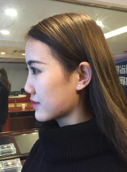 北京藝美整形鼻綜合案例分享，我都忍不住多看了兩眼