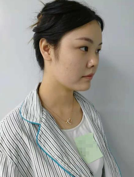 長沙雅美眼鼻整形案例分享，術(shù)后這滿滿的混血感是腫么回事