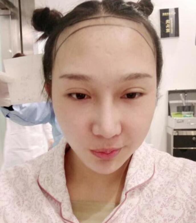 溫州新生植發(fā)種植發(fā)際線案例反饋，與大腦門說拜拜