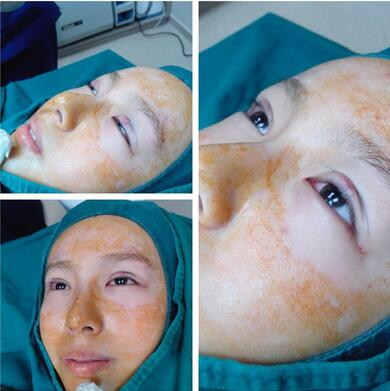 萍鄉(xiāng)麗芙整形埋線雙眼皮三個(gè)月效果分享，完全看不出來是做的